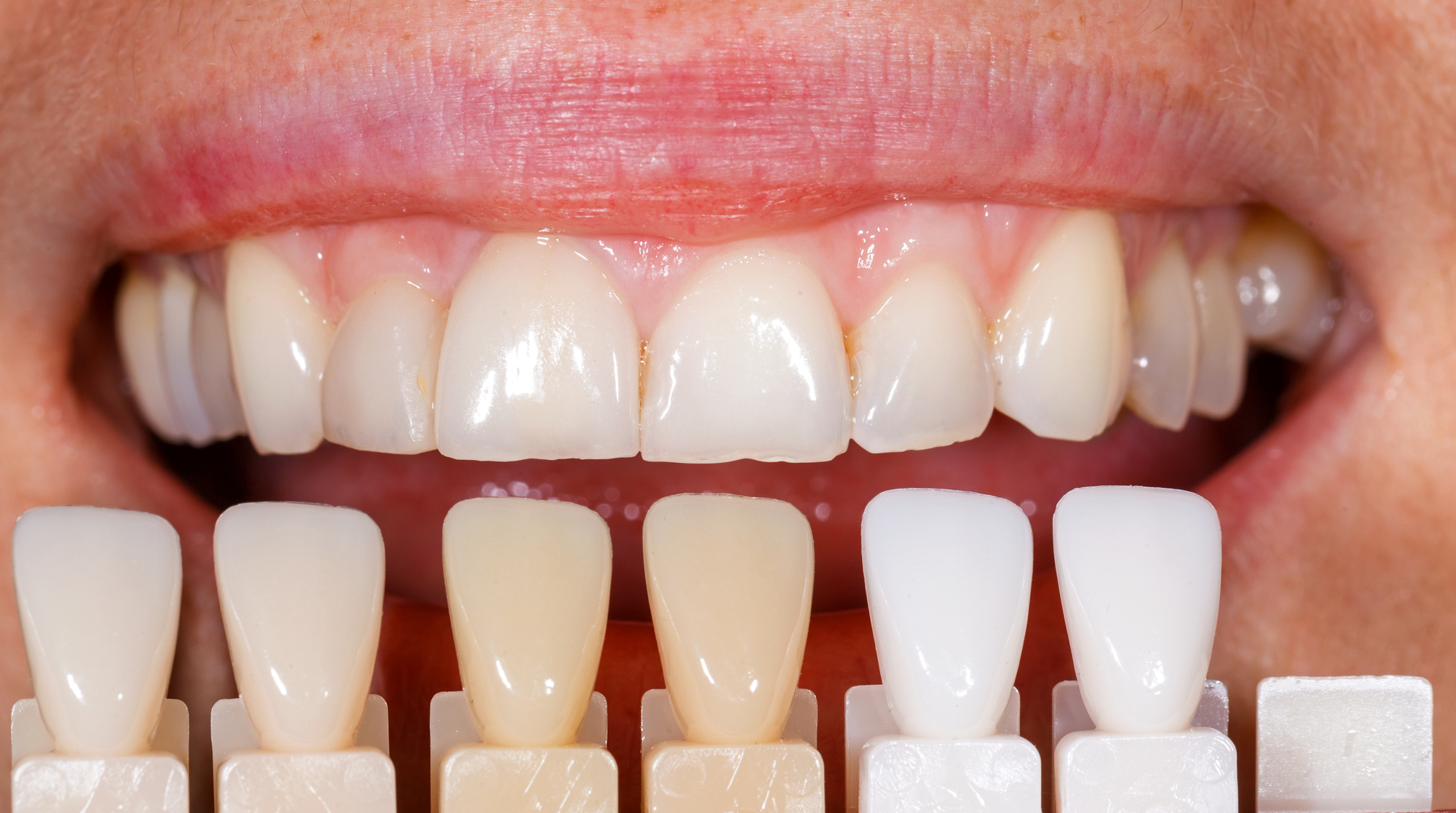 How Dental Veneers Work: A Guide By A General Dentist
