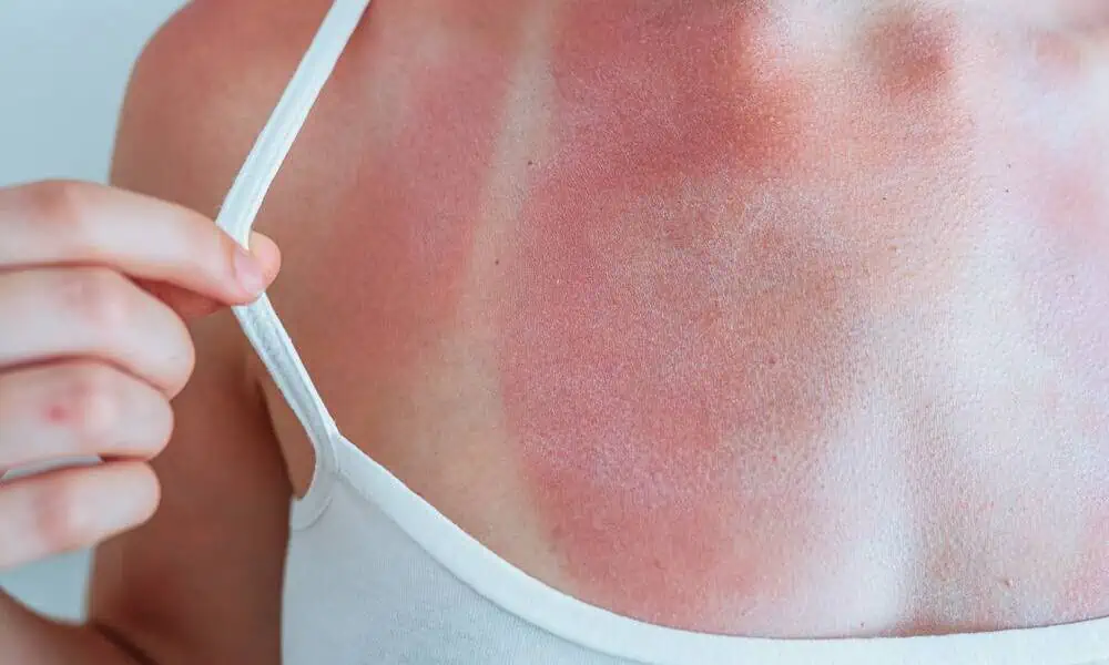 Sunburns And Dermatology: How Dermatologists Can Help