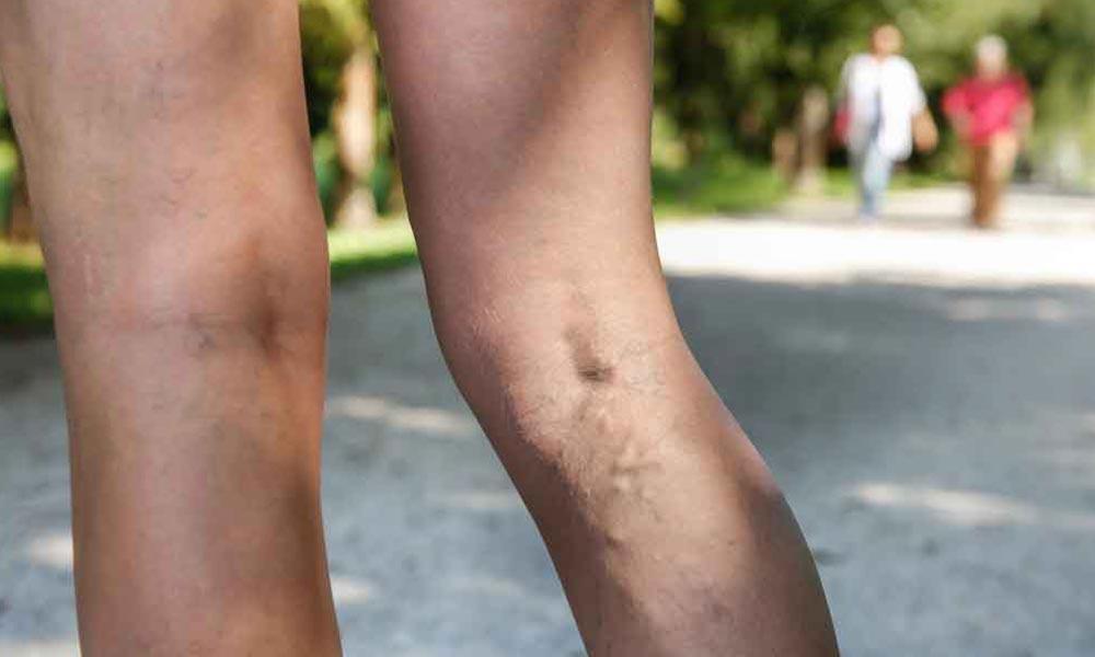 Invasive Vein Treatments