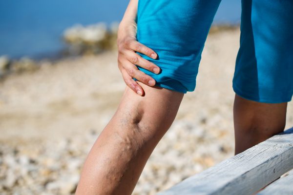 Invasive Vein Treatments