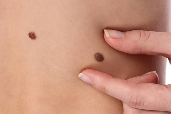 Skin Tag Removal