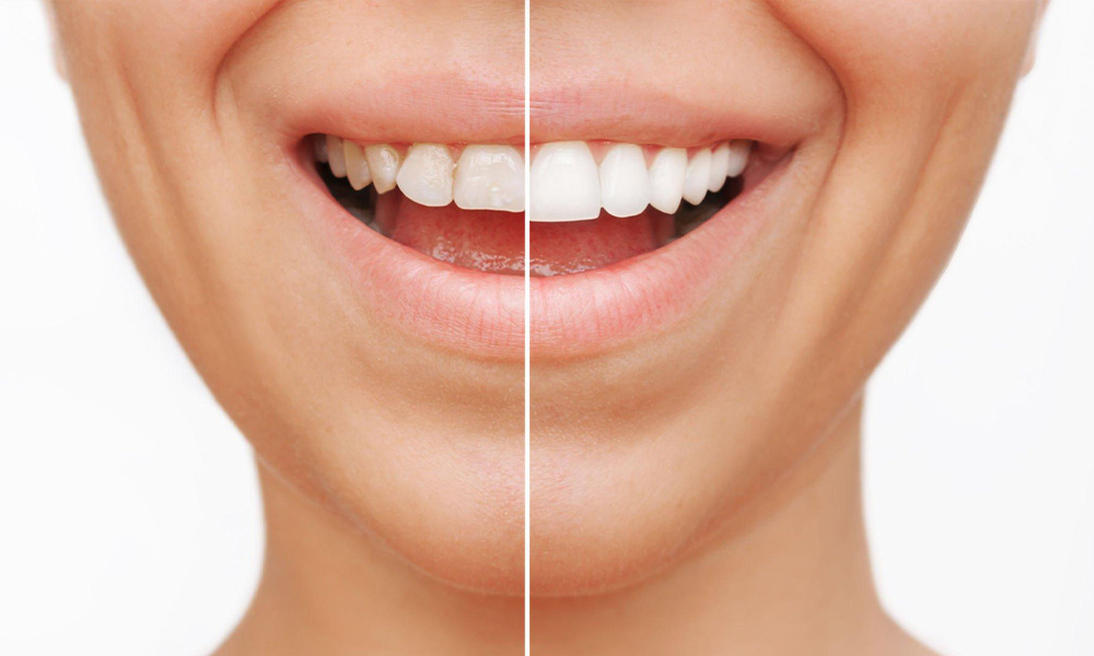 Understanding Porcelain Veneers: A General Dentist’s Perspective