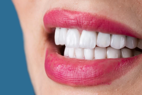 Porcelain Veneers