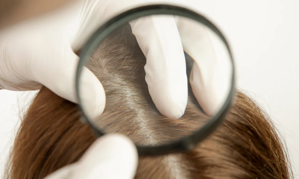 The Role Of Your Dermatologist In Treating Scalp Conditions