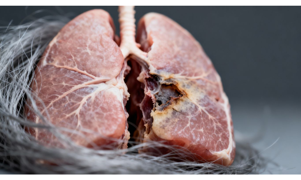 Distinguishing Mesothelioma Or Lung Cancer