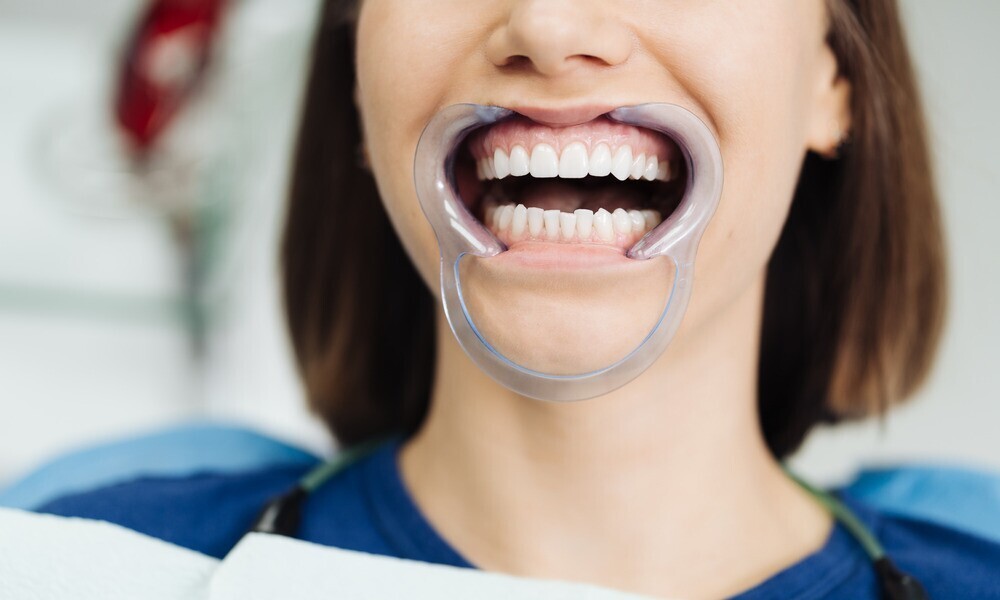What to Expect During an Orthodontic Consultation